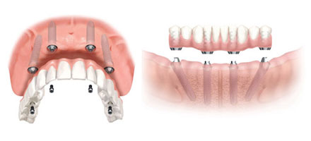 implantologia denti multipli  - avellino studio dentistico dargenio