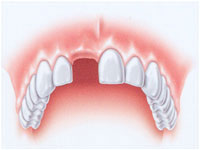 implantologia dente singolo  - avellino studio dentistico dargenio