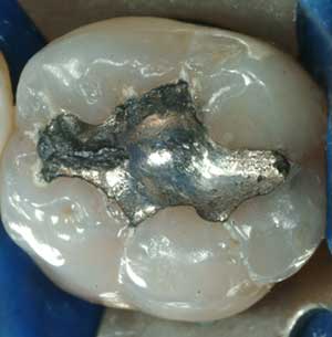 rimozione amalgama argento avellino studio dentistico dargenio