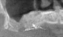 tac-prechirurgica-avellino-studio-dentistico-dargenio