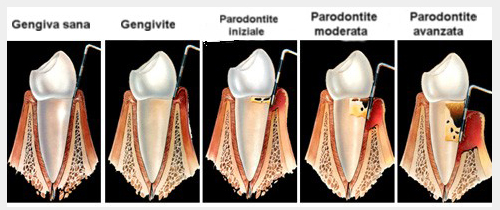 recessioni-gengivali-avellino-studio-dentistico-dargenio