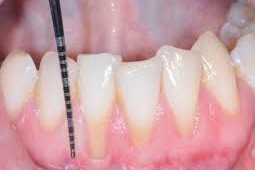 recessioni-gengivali-avellino-studio-dentistico-dargenio