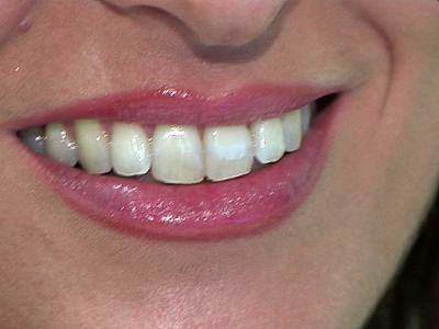 Dal bianco splendente alle faccette, il sorriso perfetto si crea al computer