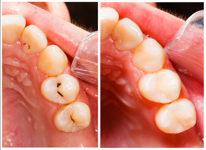 Conservativa ed Endodonzia