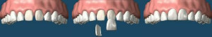 faccette composito estetica avellino studio dentistico dargenio