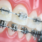 ortodonzia-fissa-avellino-studio-dentistico-dargenio-1