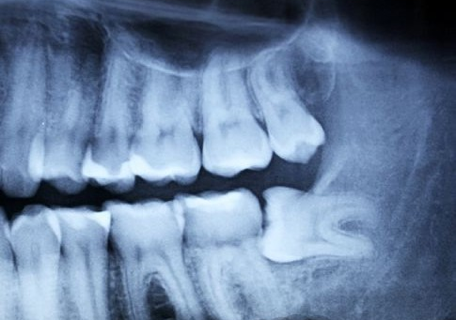 tac-prechirurgica-avellino-studio-dentistico-dargenio