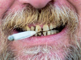 Fumo e danno parodontale: tabacco fa perdere gli elementi dentari