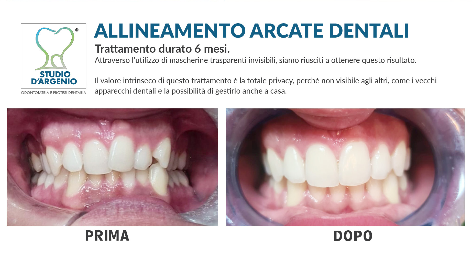 ALLINEAMENTO ARCATE DENTALI