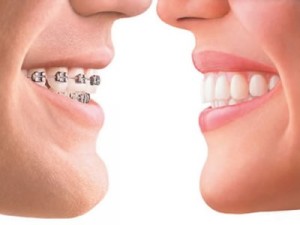 ortodonzia-fissa-avellino-studio-dentistico-dargenio