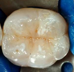 otturazione estetica bianca avellino studio dentistico dargenio