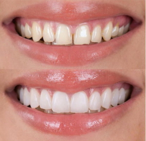 faccette composito avellino studio dentistico dargenio
