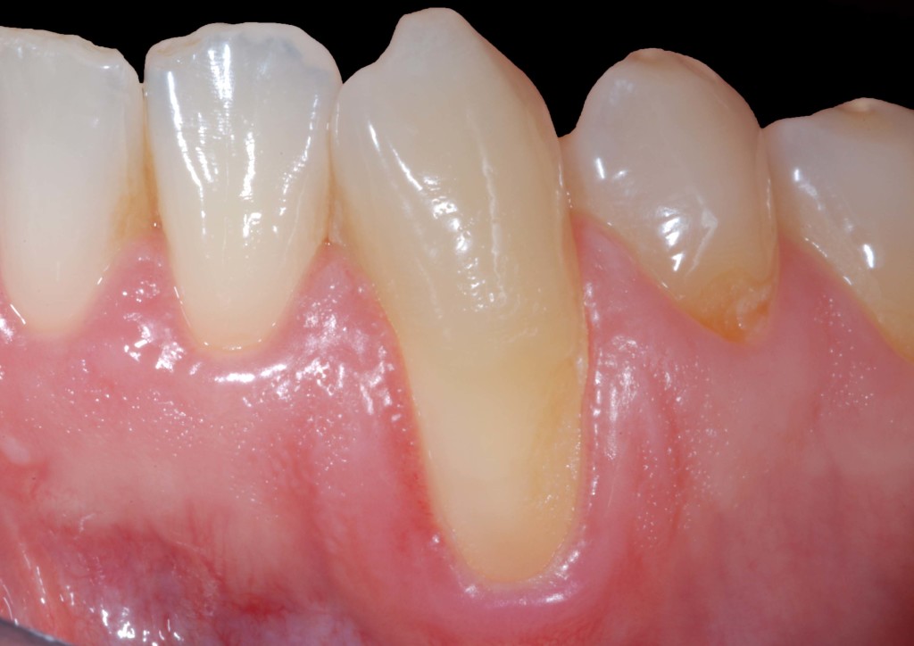 recessioni-gengivali-avellino-studio-dentistico-dargenio
