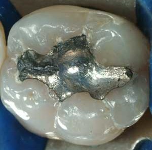 rimozione amalgama argento avellino studio dentistico dargenio