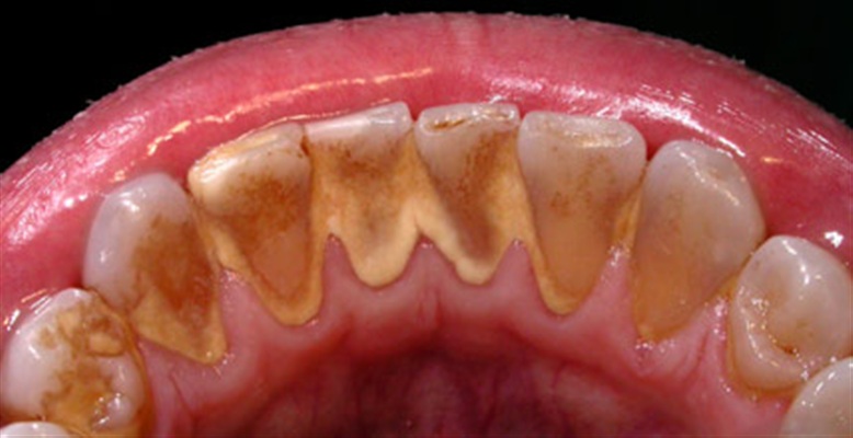 recessioni-gengivali-avellino-studio-dentistico-dargenio