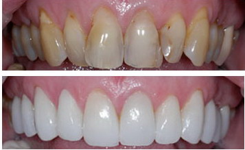 faccette composito estetica avellino studio dentistico dargenio