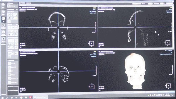 Monitore della scansione tac 3d